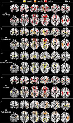 Disrupted White Matter Integrity and Structural Brain Networks in Temporal Lobe Epilepsy With and Without Interictal Psychosis